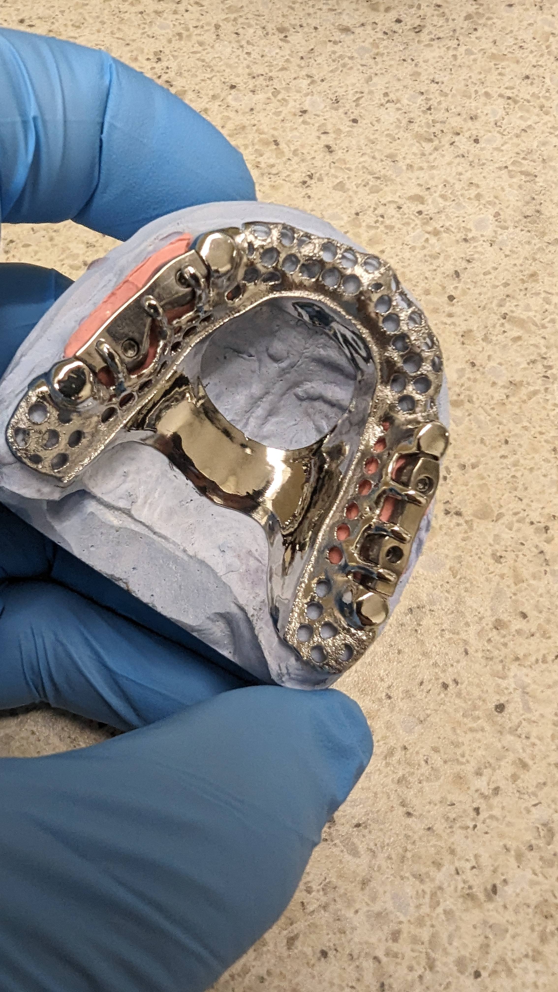 Full upper framework with retention and clasps