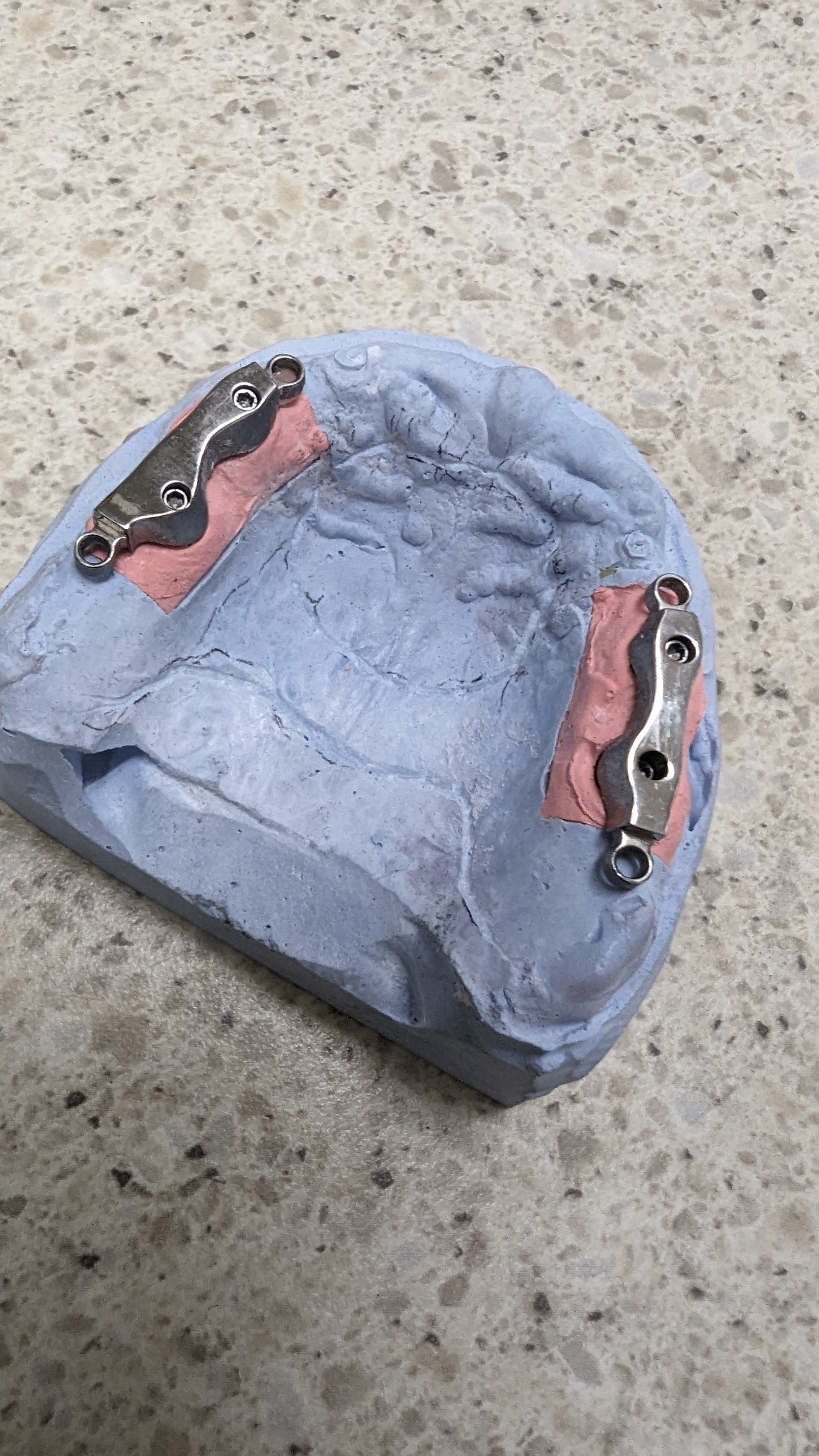 Metal clasps on dental model