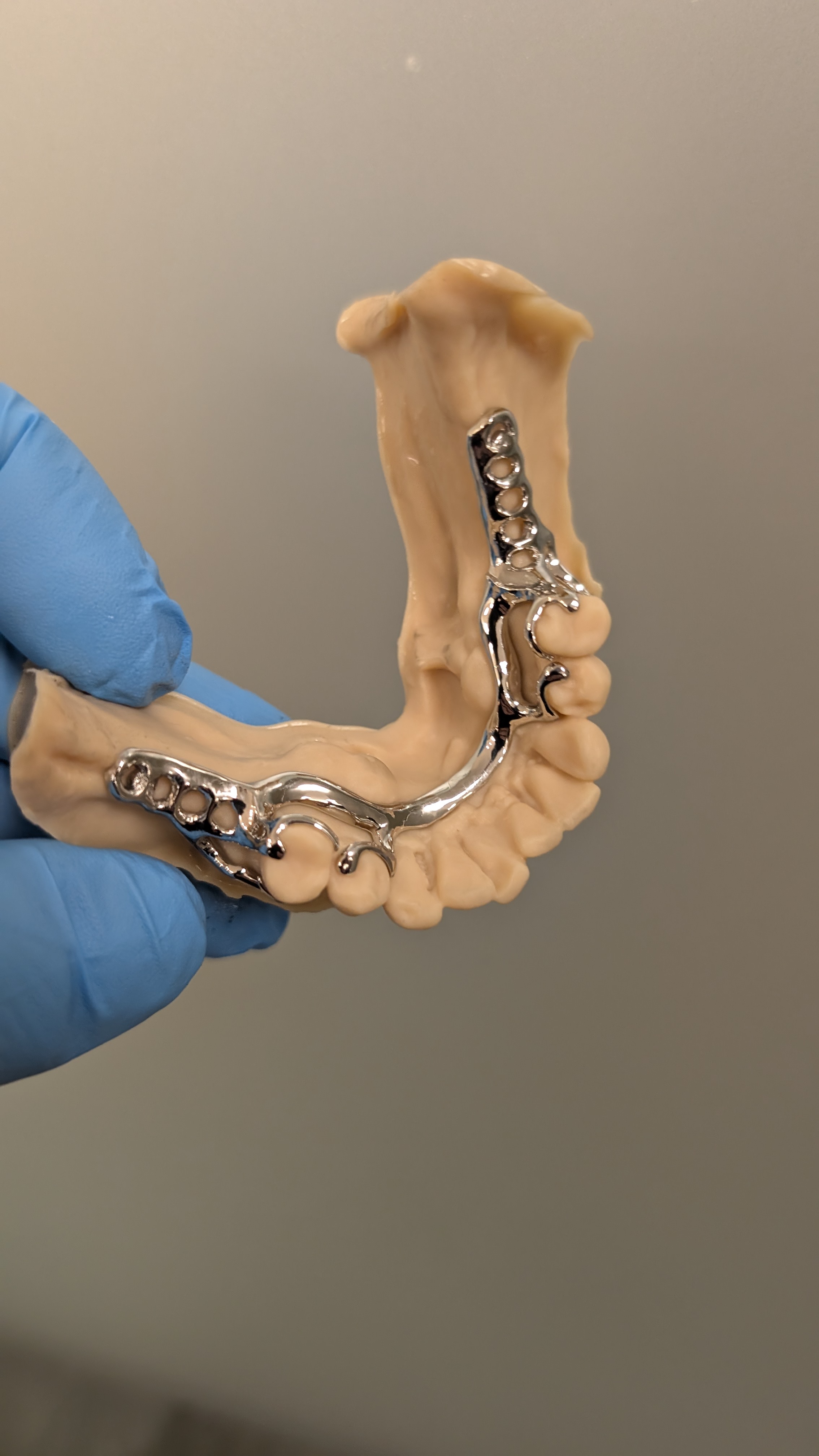 Lower partial framework on dental model - front view