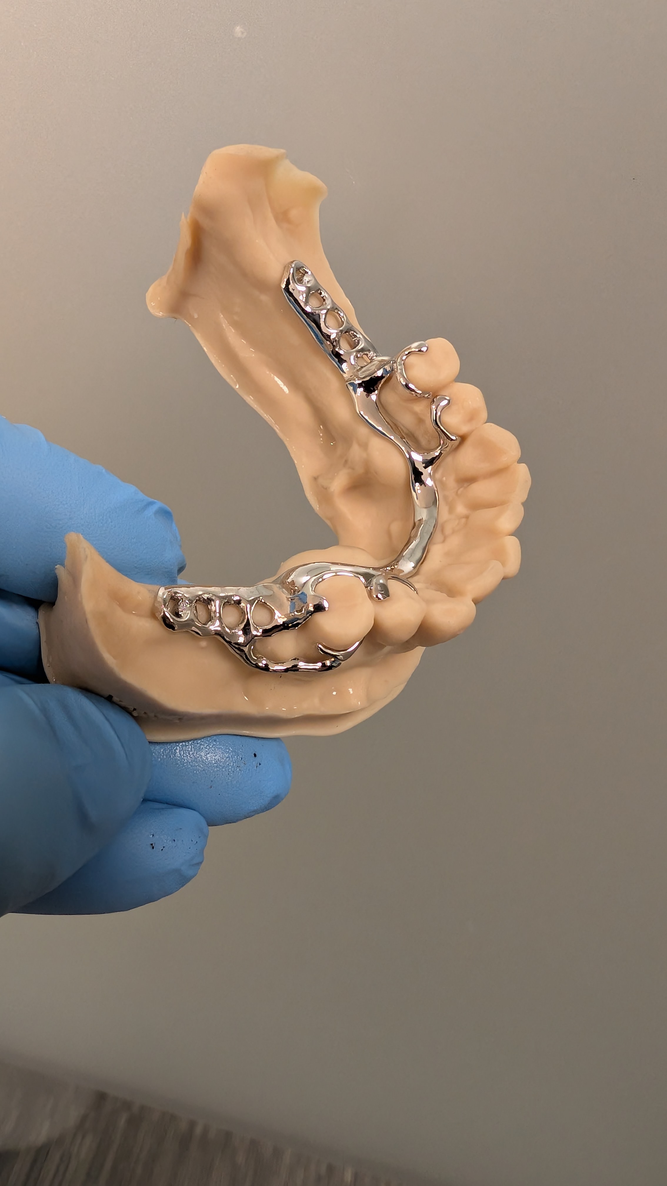 Lower partial framework on dental model - angled view