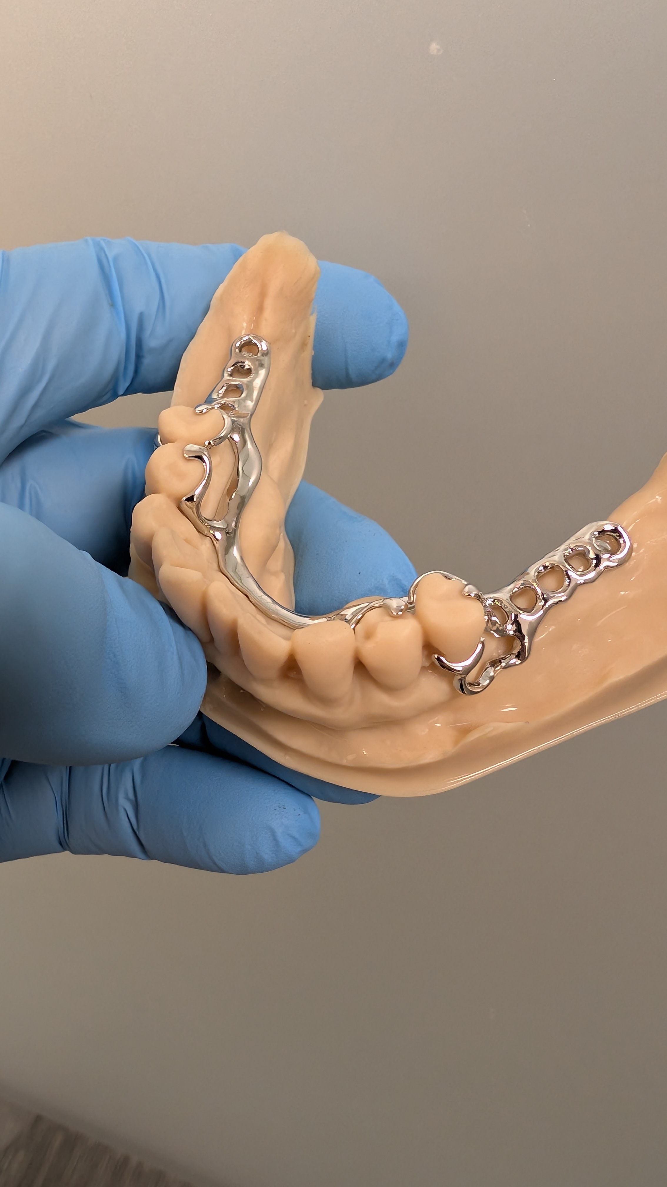 Lower partial framework on dental model - occlusal view