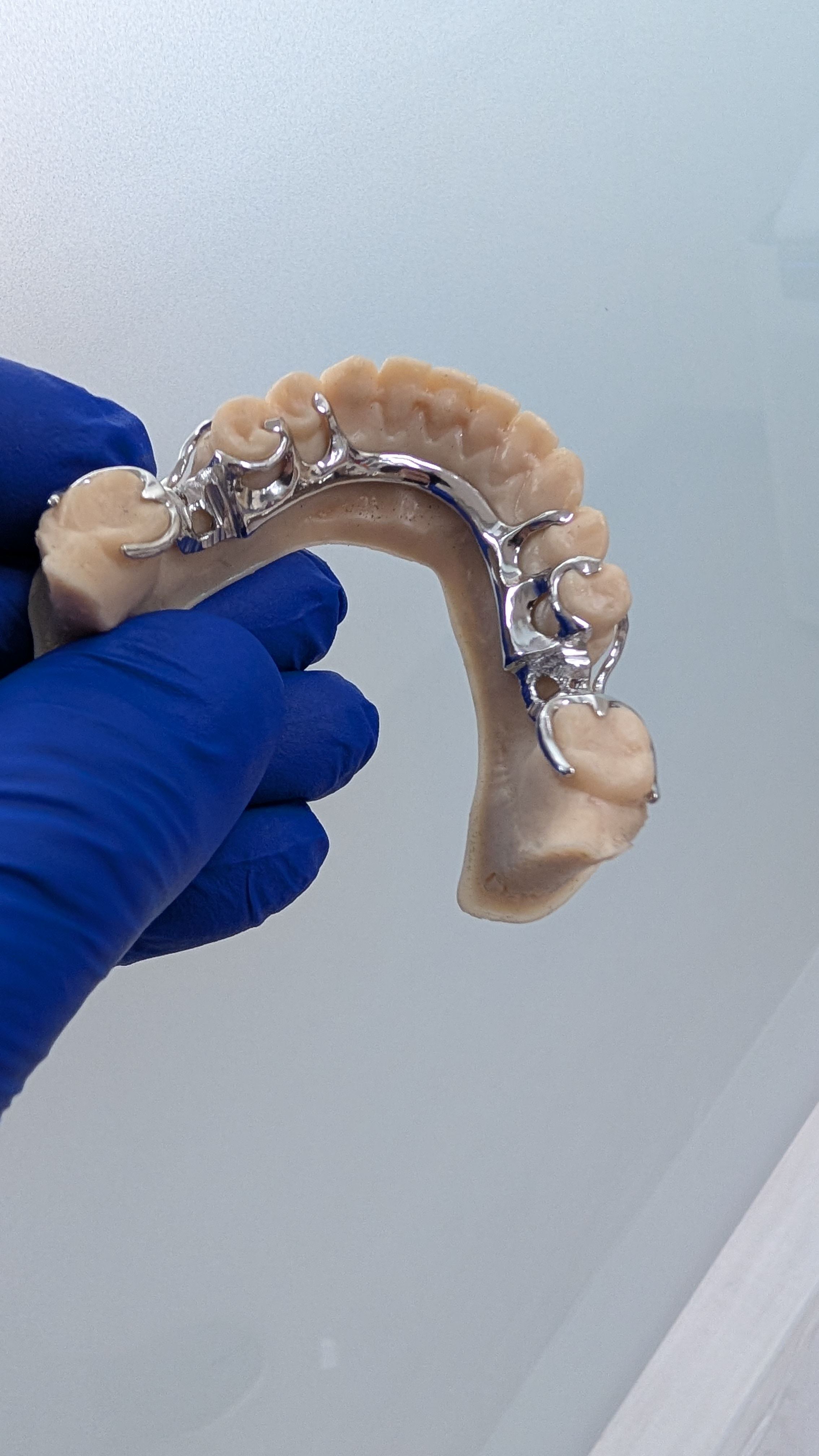 Upper partial framework held with blue glove