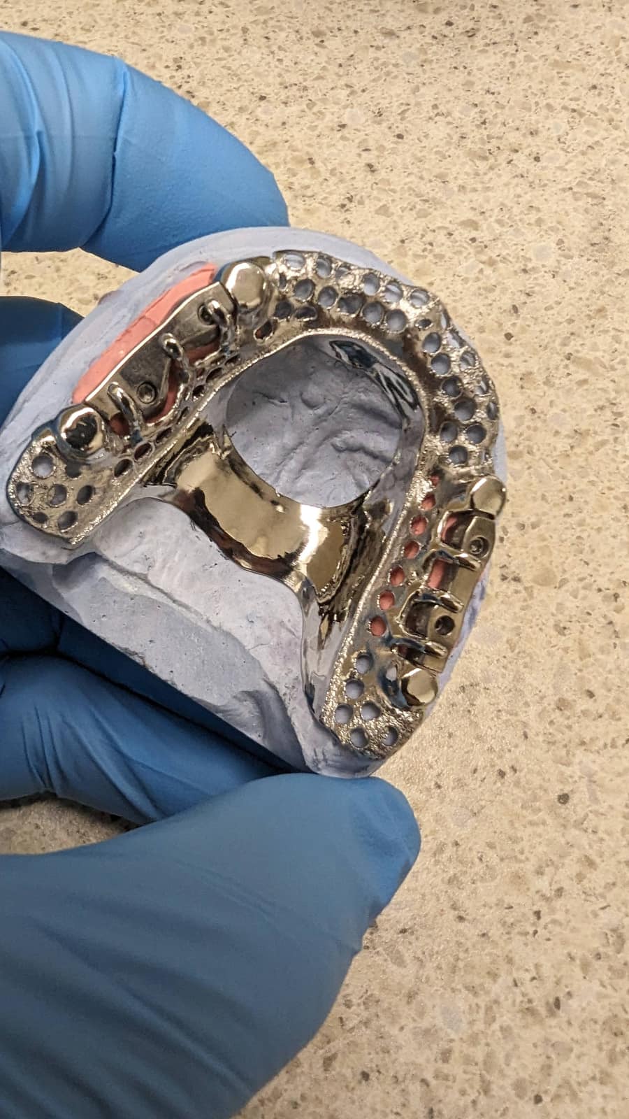 Close view of a finished cobalt-chrome partial denture framework