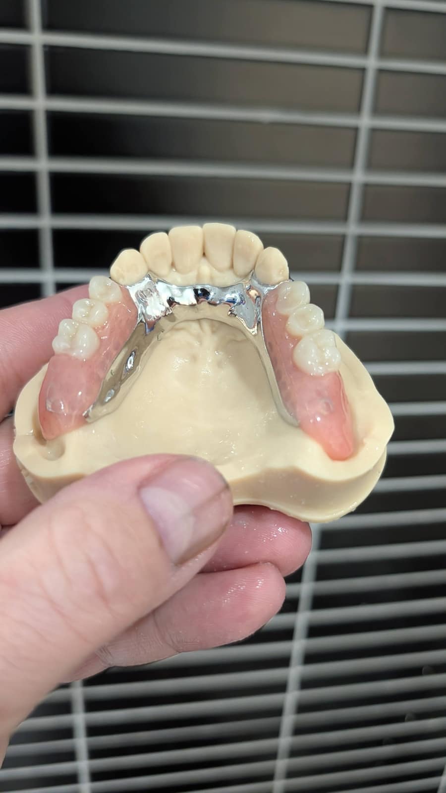 Upper framework with acrylic teeth on a model