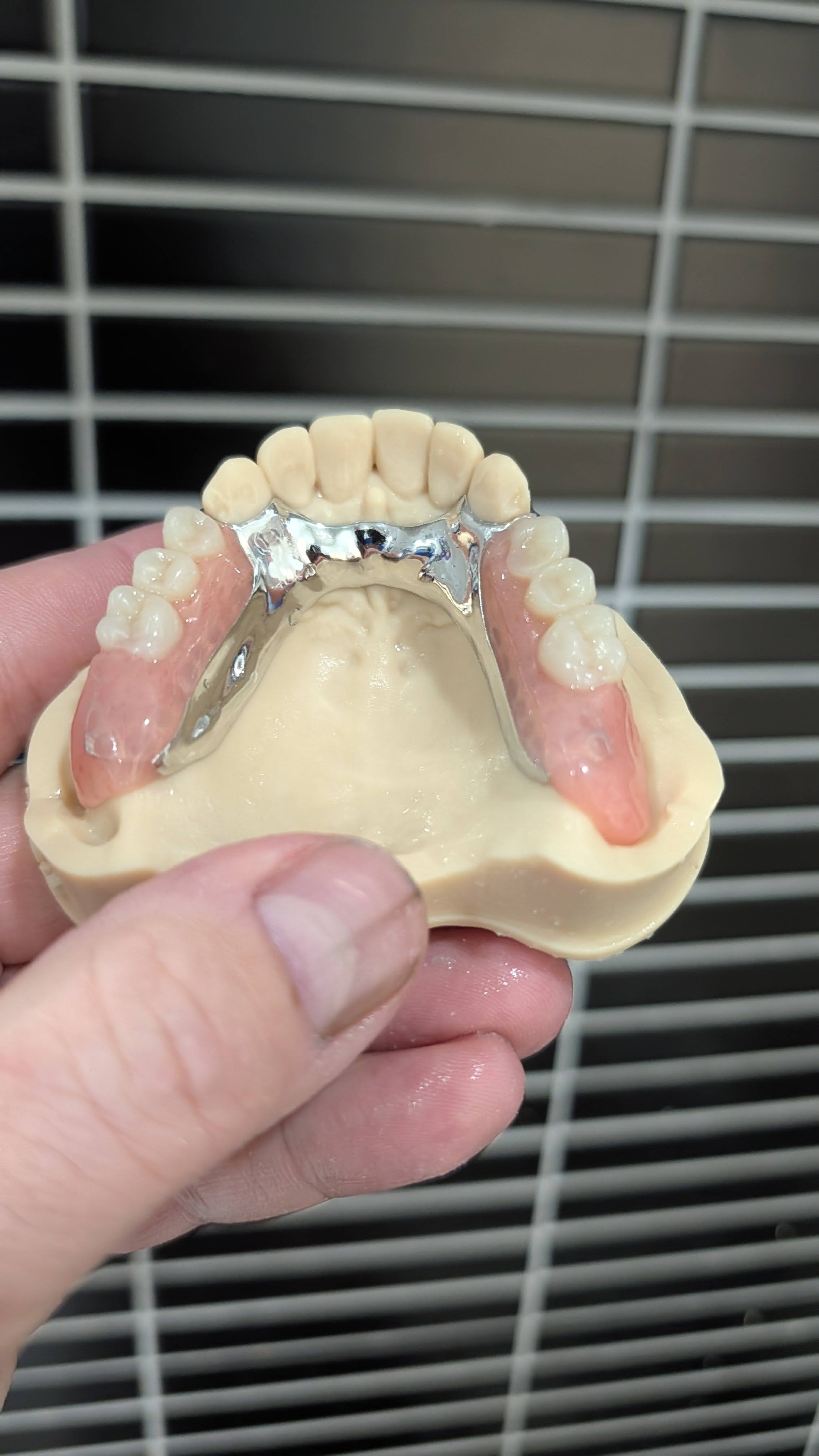 Finished upper partial denture with teeth, front view