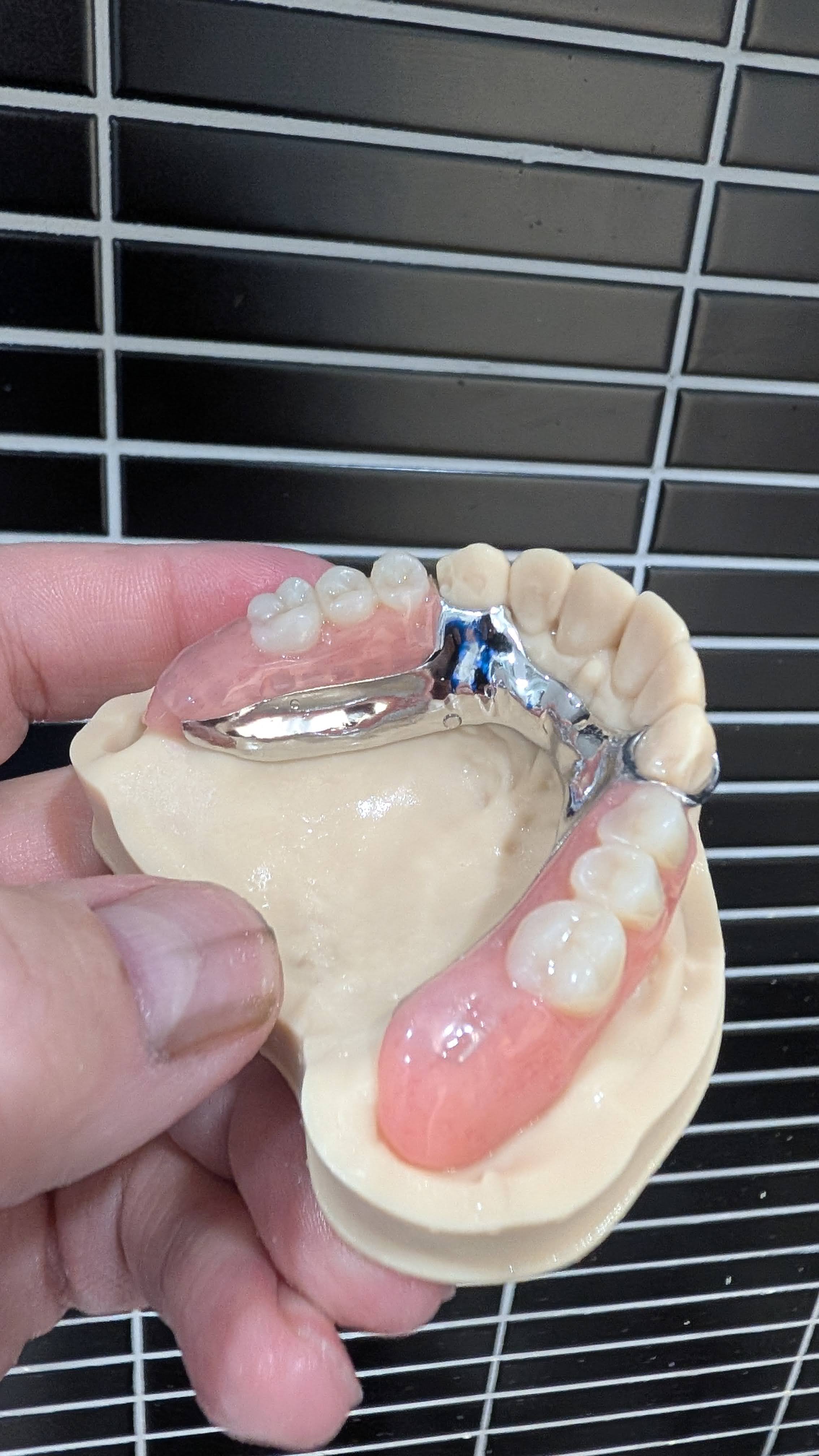 Lower partial denture on model with chrome framework