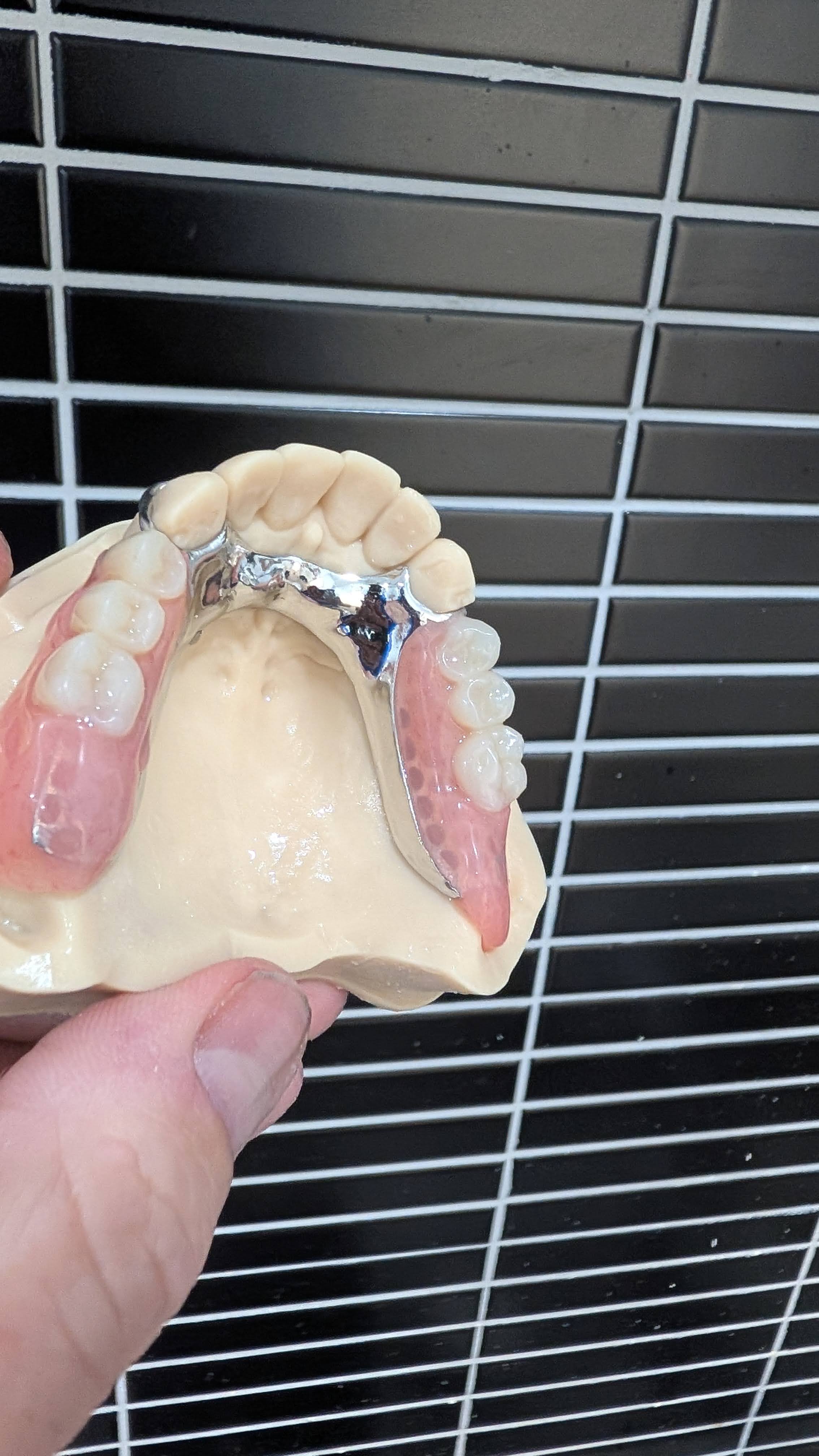 Upper partial denture palatal view with framework